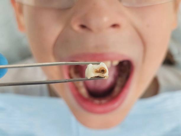 Best Emergency Dental Extractions in Mercer, PA
